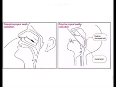 Oral Nasal Swab with Breakpoint for Virus Sample Collection